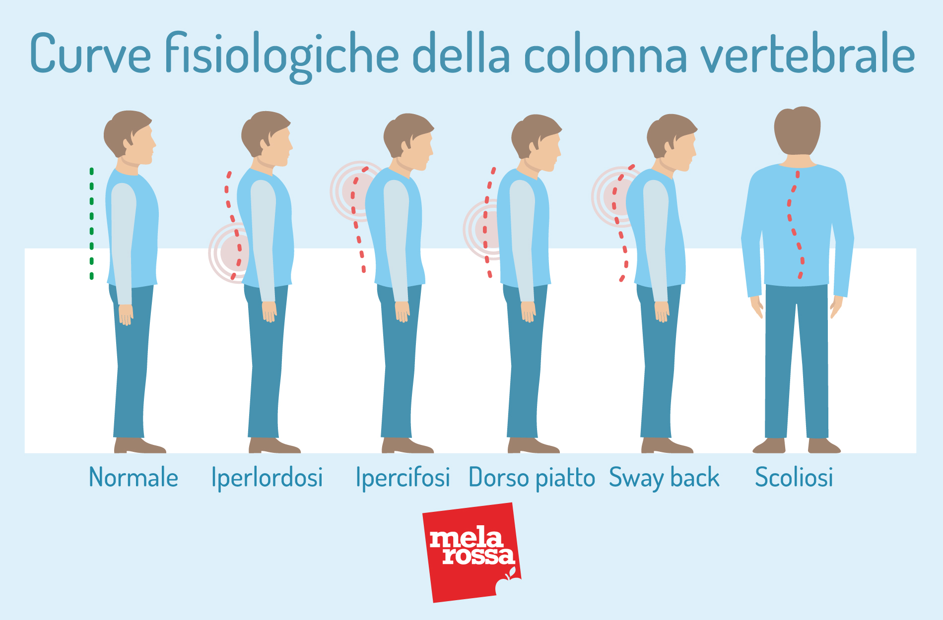 scoliosi e curve fisiologiche 