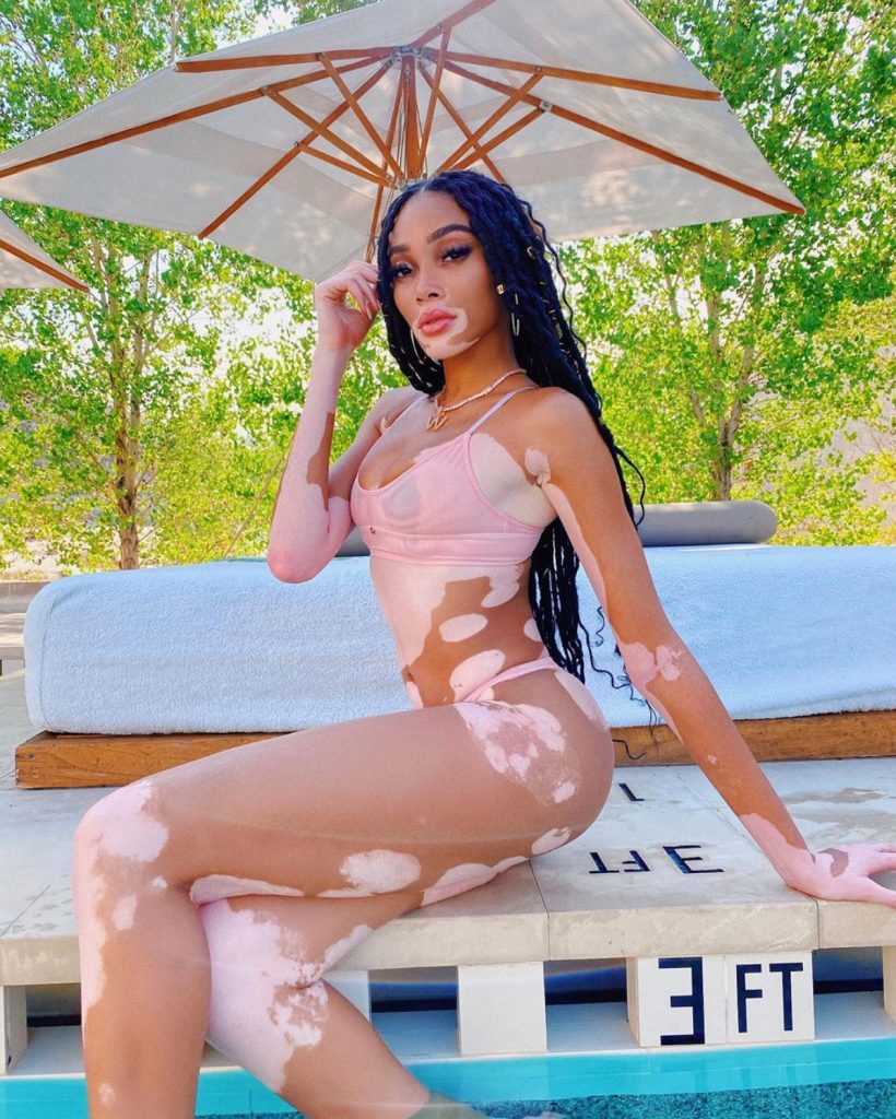 vitiligine winnie harlow