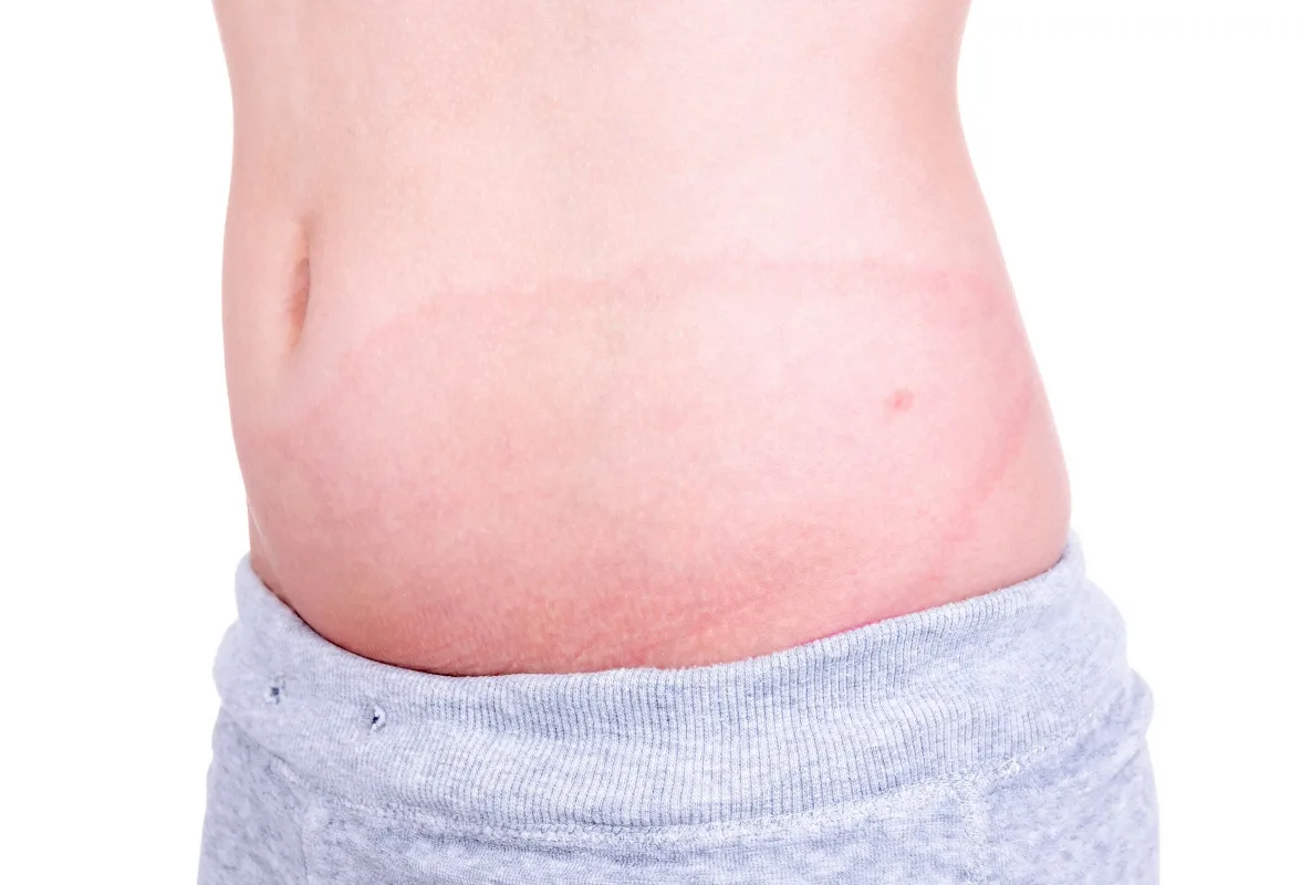 Malattia Di Lyme Cos E Cause Sintomi Diagnosi Cure E Prevenzione