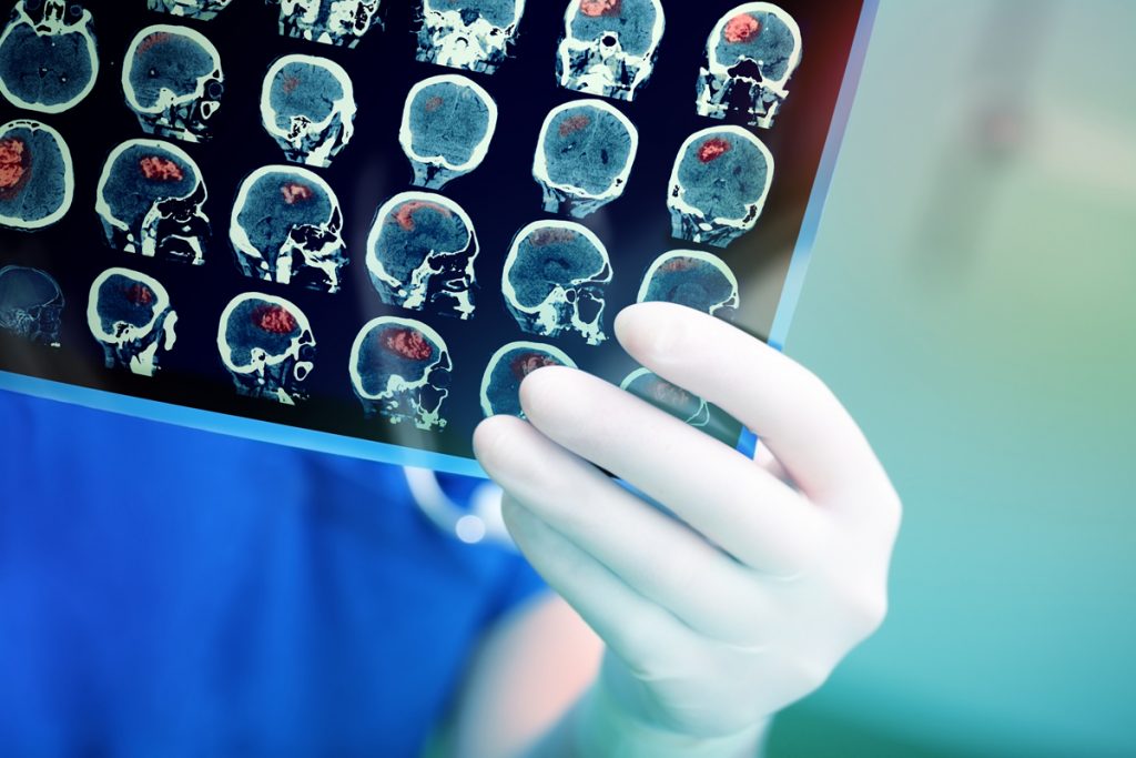 ictus cerebrale