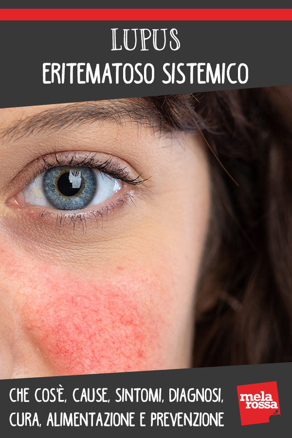 lupus eritematoso sistemico: cos'è, cause, sintomi, cura e prevenzione