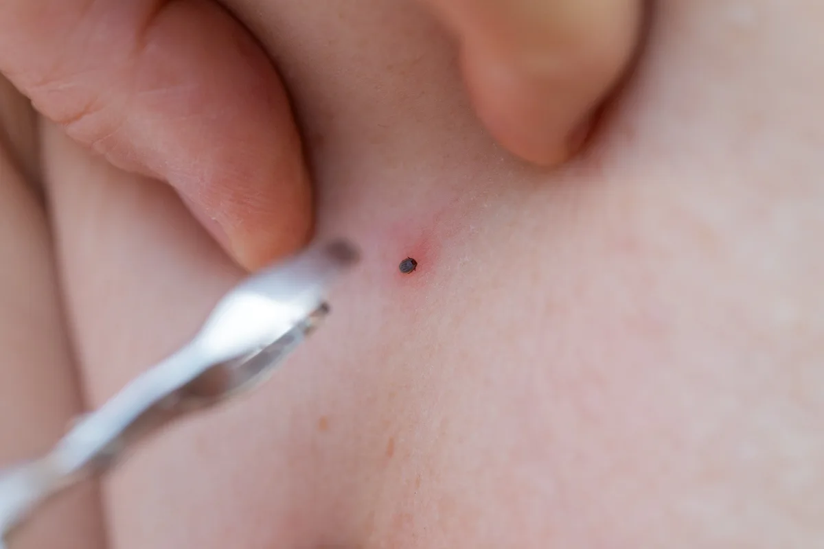 Cosa E Il Morbo Di Lyme Sintomi E Diagnosi