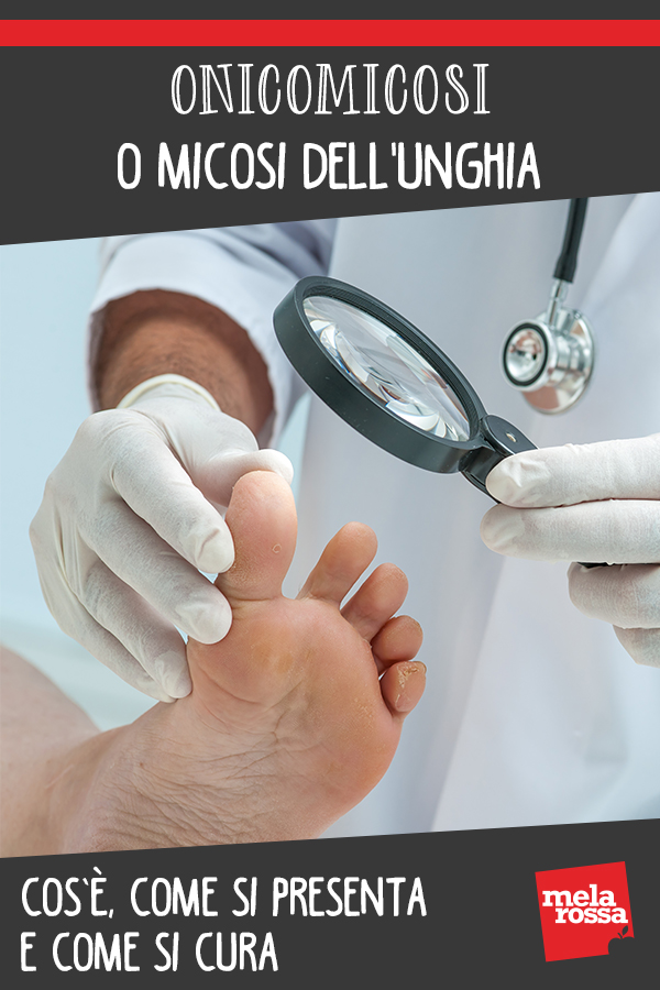 Onicomicosi o micosi dell'unghia: cos'è, come si presenta e come si cura