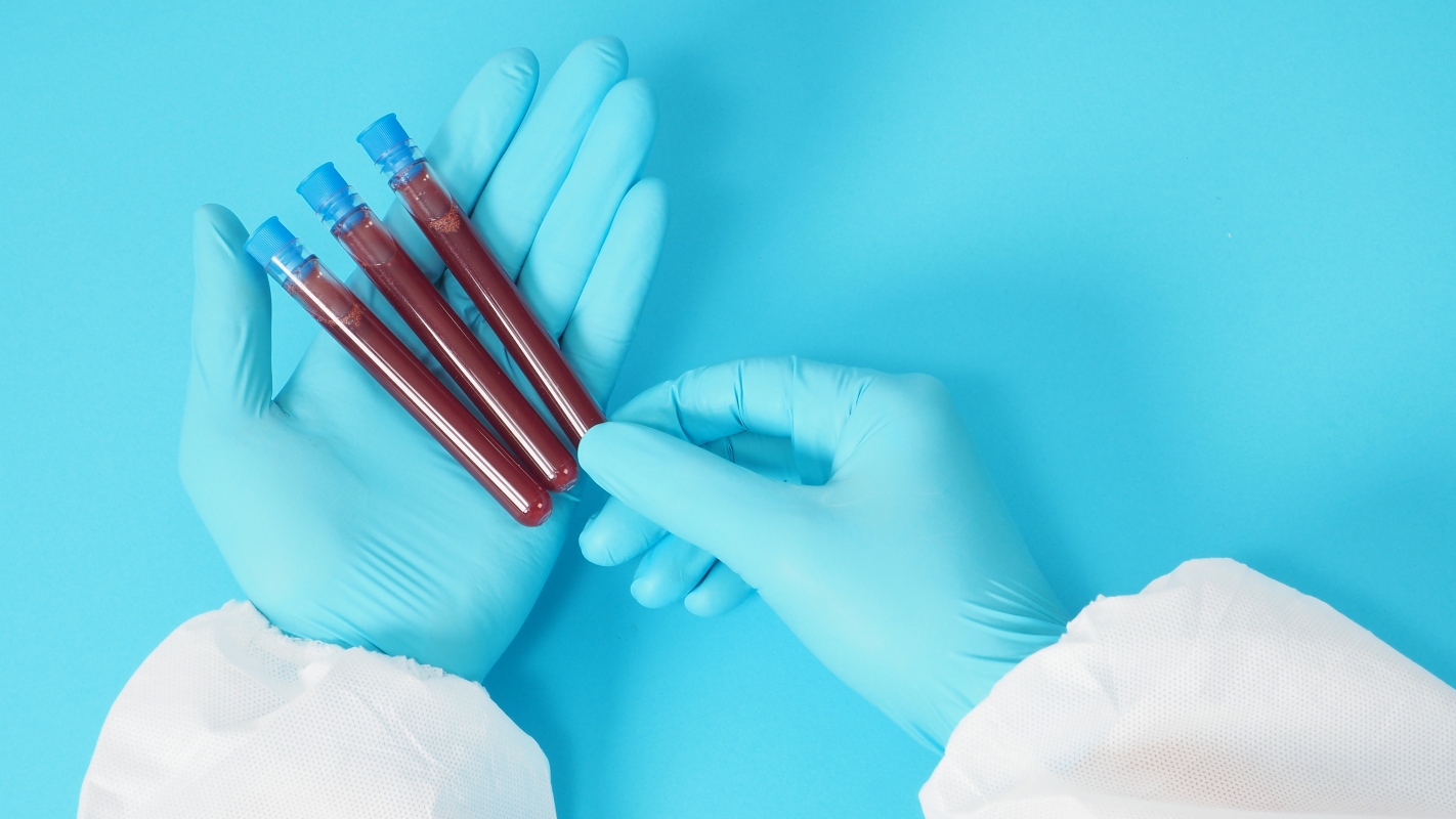 trigliceridi: valori, esame del sangue