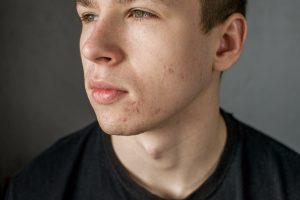 Acne: le diverse forme e come curarla anche a tavola