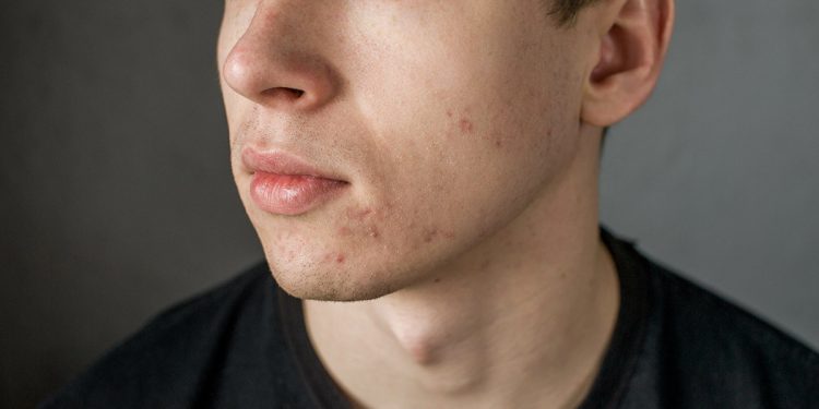 L'acne, come si manifesta