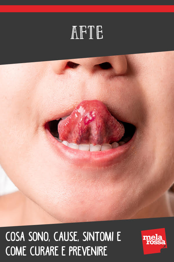 Afte: cosa sono, cause, sintomi e come curare e prevenire