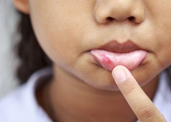 Una bambina che mostra le afte in bocca