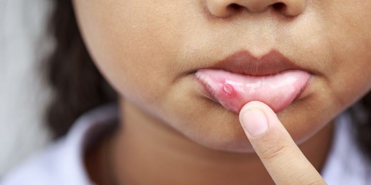 Una bambina che mostra le afte in bocca