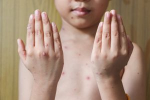 Morbillo: cos’è, cause, sintomi, diagnosi, decorso, e cure