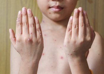 morbillo: cos'è, cause, sintomi, prevenzione e cure