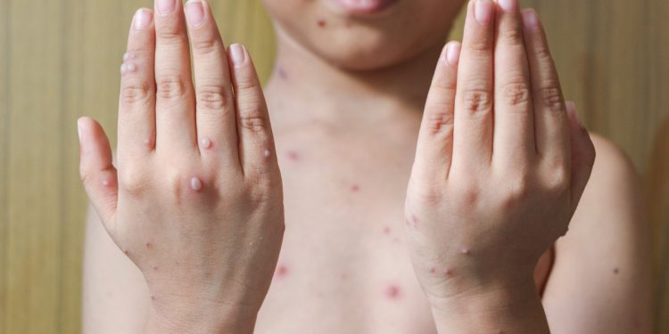 morbillo: cos'è, cause, sintomi, prevenzione e cure