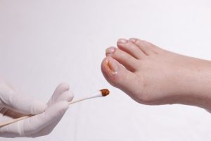 Unghia incarnita: cos’è, cause, sintomi, cure e prevenzione