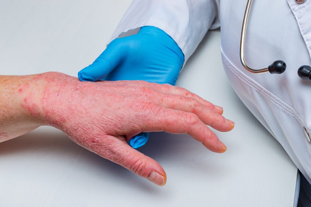 dermatite atopica adulto