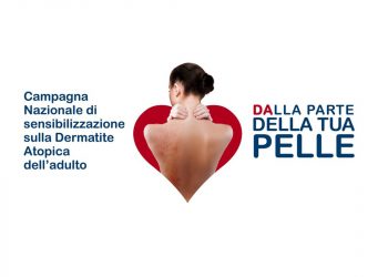 Dermatite atopica: il 26 settembre parte la campagna "Dalla parte della tua pelle"