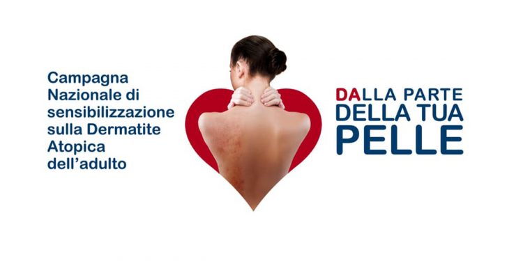 Dermatite atopica: il 26 settembre parte la campagna "Dalla parte della tua pelle"