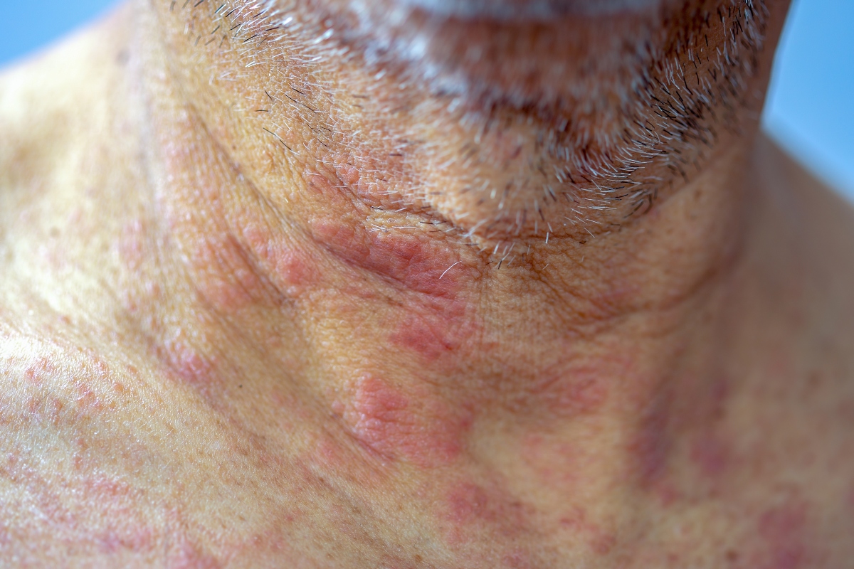 eczema complicazioni