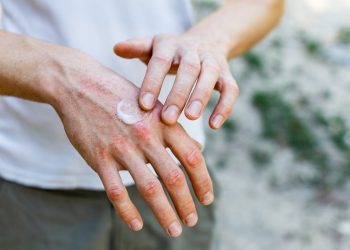 eczema: cos'è, cause, sintomi e cure