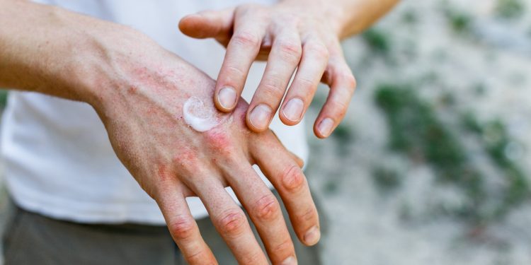 eczema: cos'è, cause, sintomi e cure