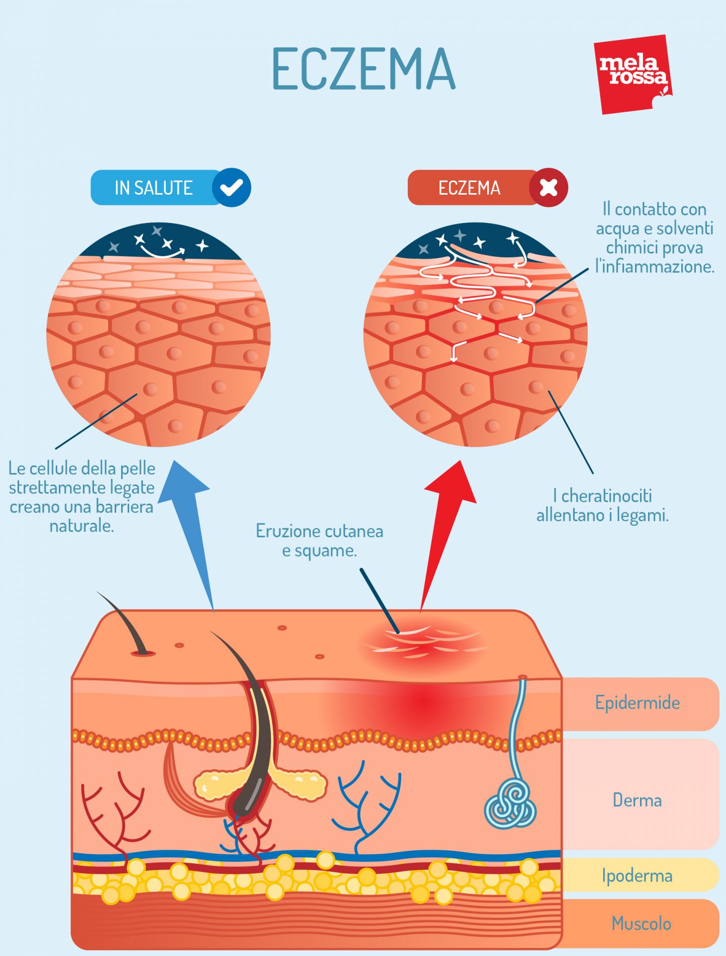 Eczema: cos'è