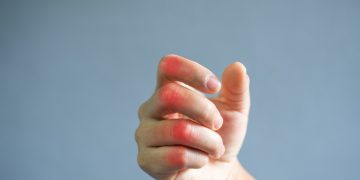Una mano colpita da gotta
