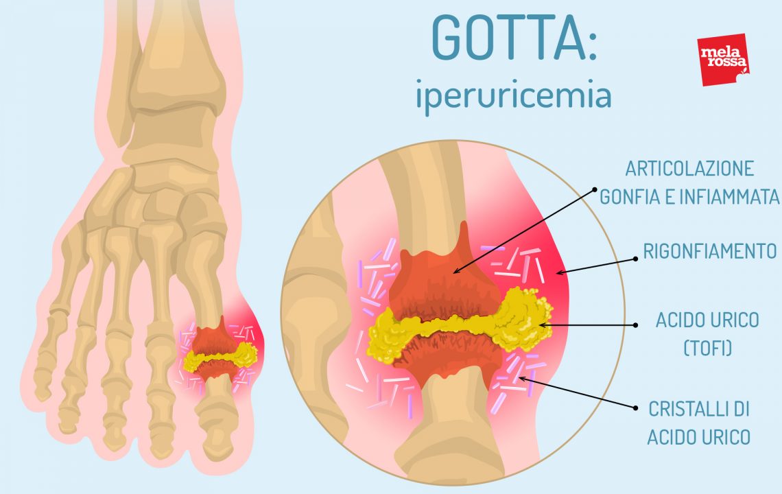 Gotta: cos'è, cause, sintomi, cure e prevenzione - Melarossa