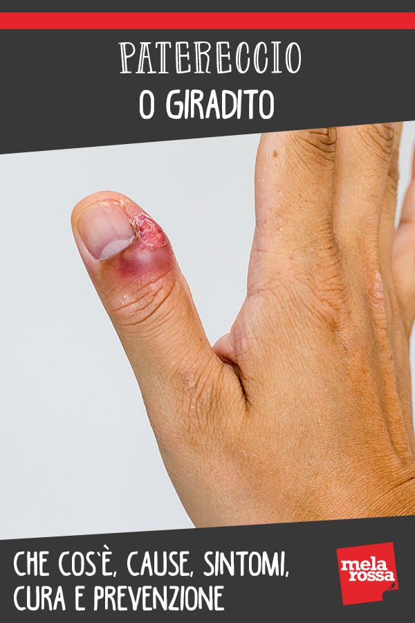 patereccio o giradito: cos'è, cause, sintomi e cure