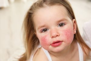 Quinta malattia: cos’è, trasmissione e contagio, sintomi, cure e prevenzione
