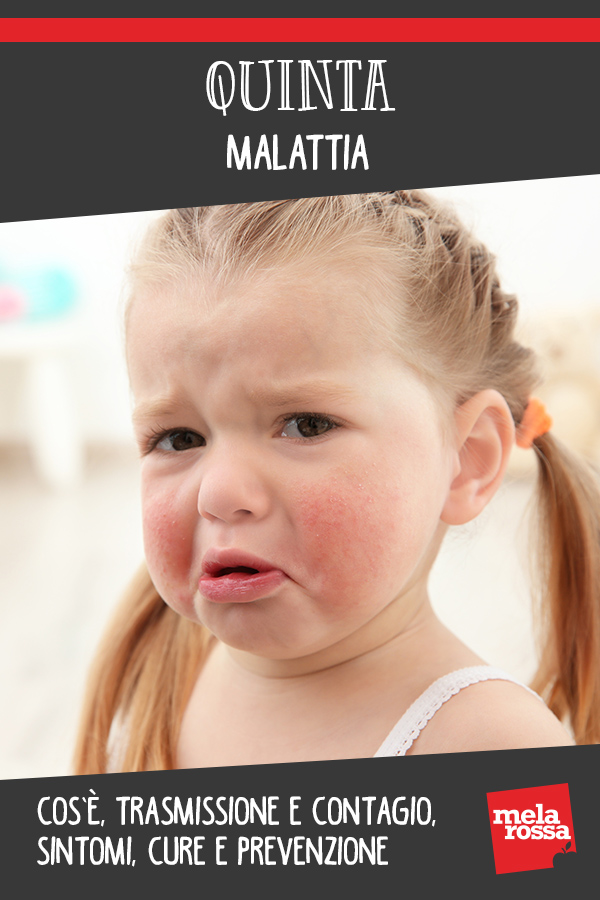 Quinta malattia: cos'è, cause, sintomi e cure