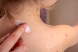 Rosolia: cos’è, cause, contagio, sintomi, diagnosi, cure e prevenzione
