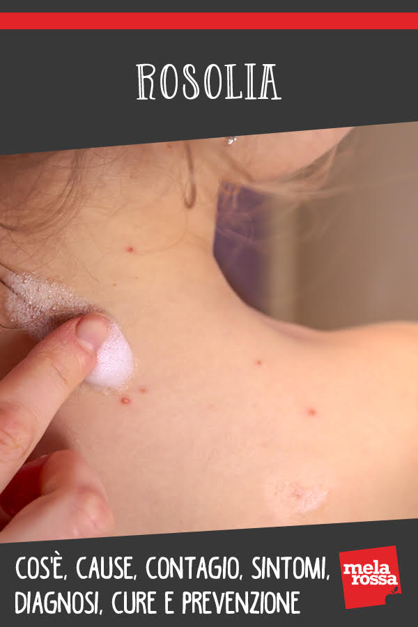 rosolia cos e cause sintomi cure