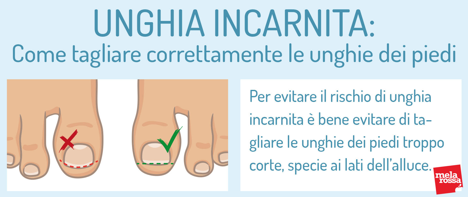 Unghia incarnita: come tagliare correttamente le unghie dei piedi