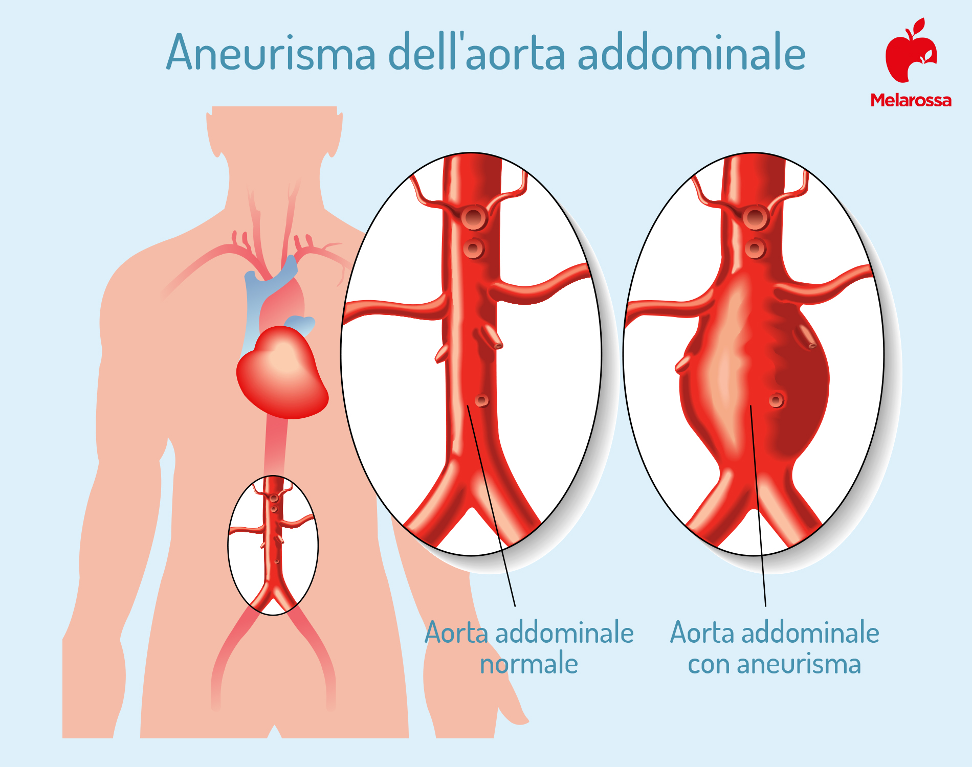 aneurisma aorta addominale 