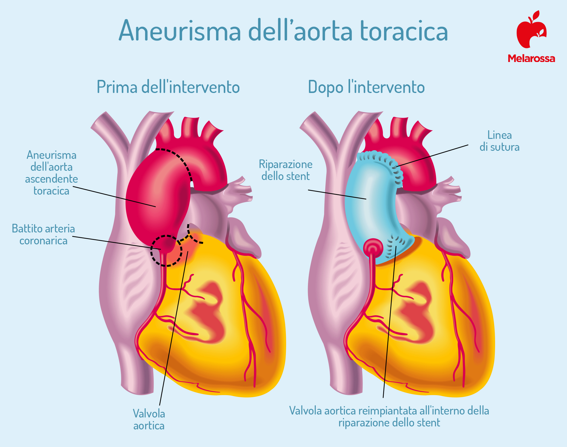 aneurisma aorta addominale prima e dopo intervento