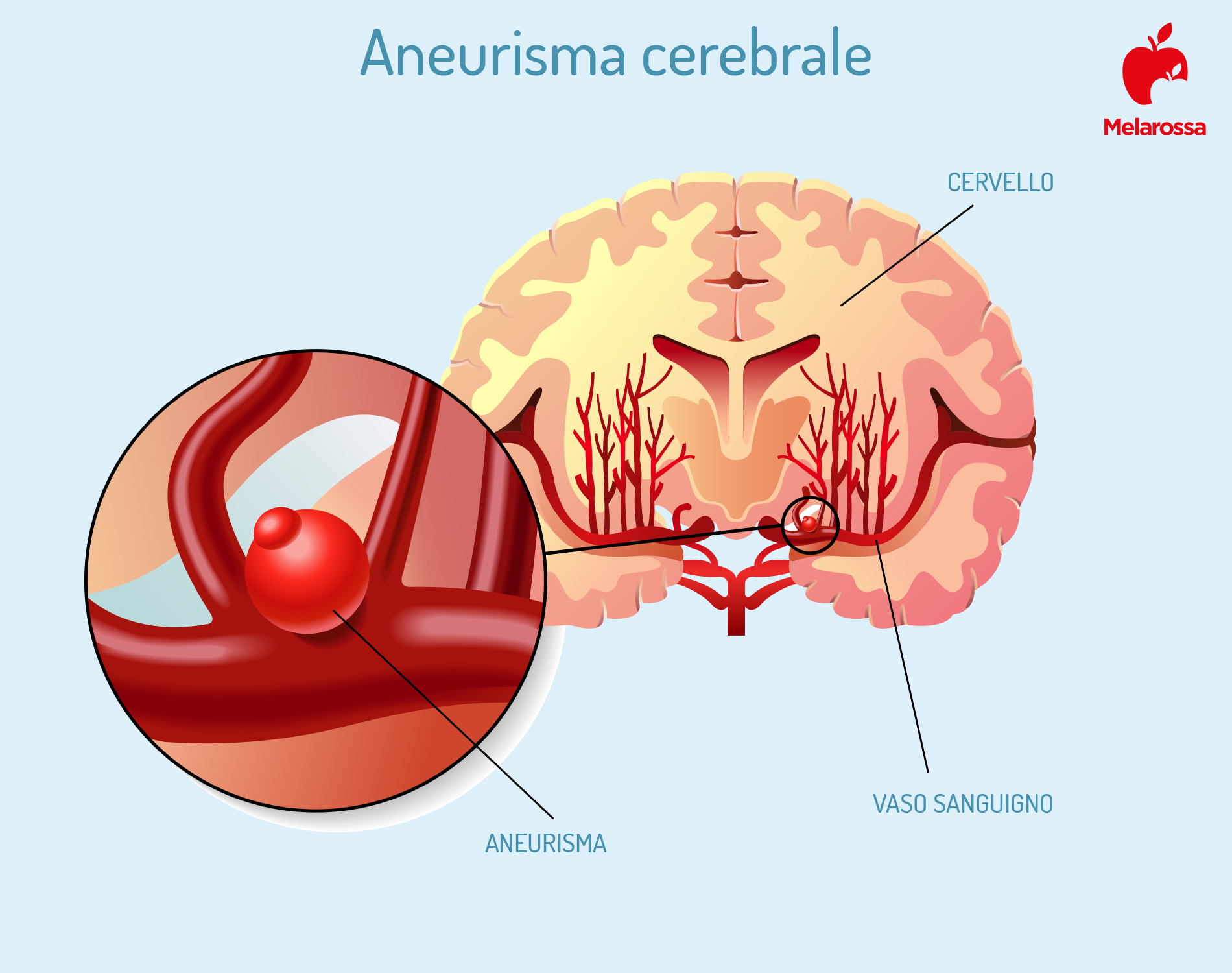 aneurisma cerebrale 