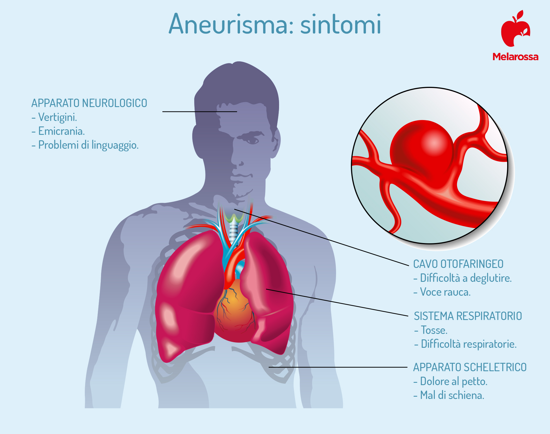 i sintomi dell'aneurisma