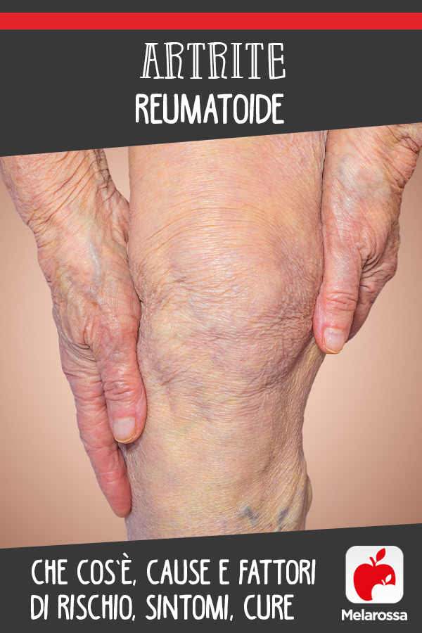 artrite reumatoide: cos'è, cause, sintomi, cure