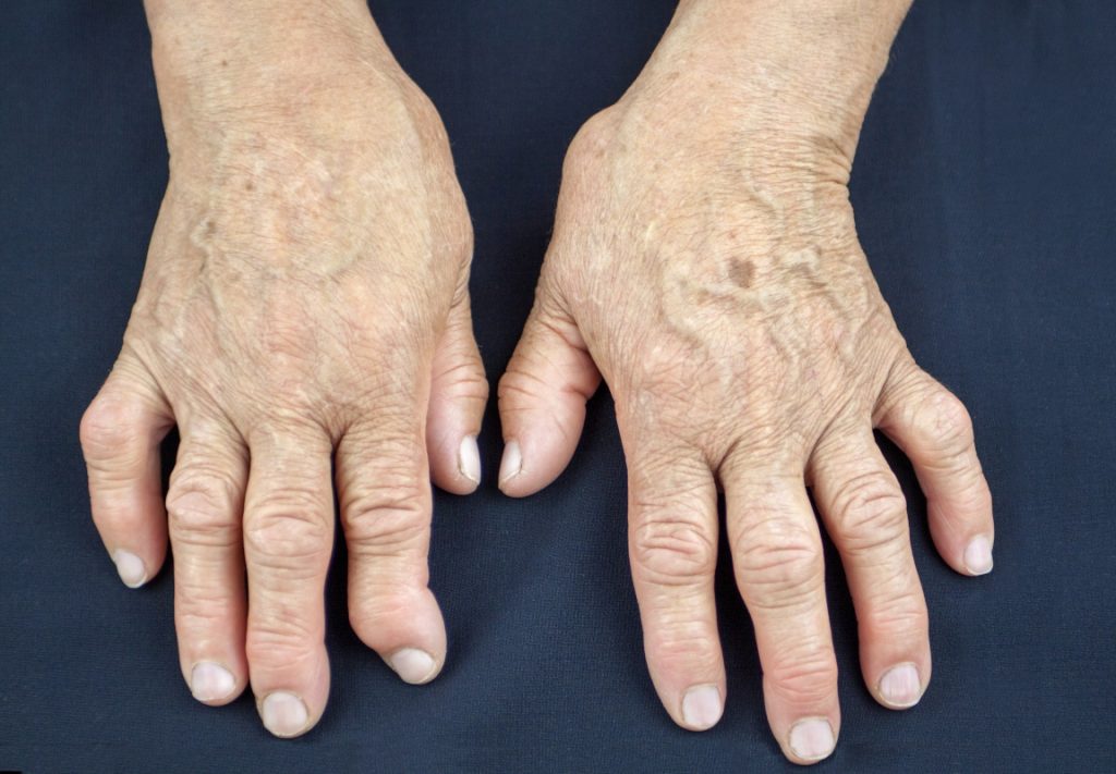 artrite reumatoide e artrosi: differenze