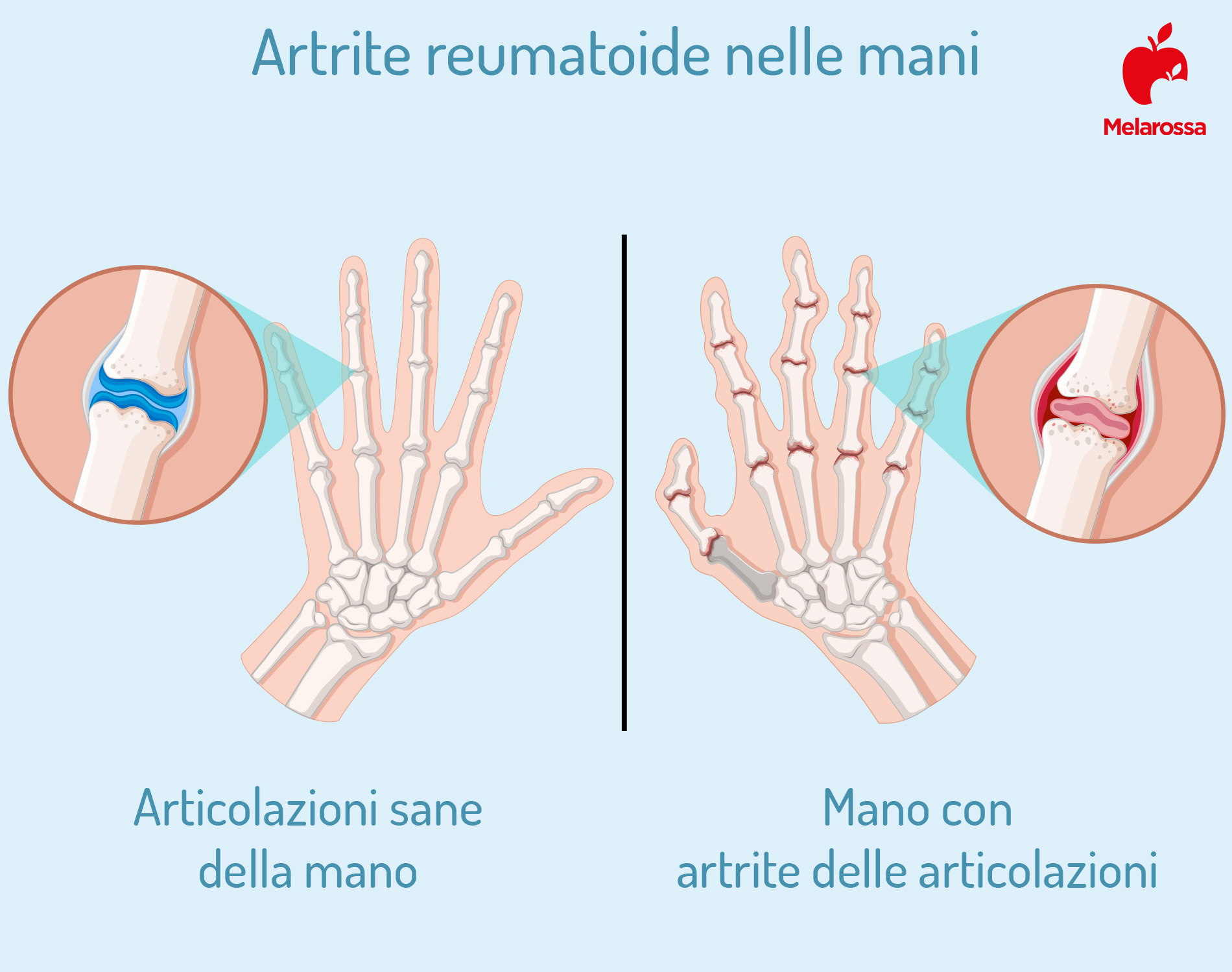 artrite reumatoide: mani
