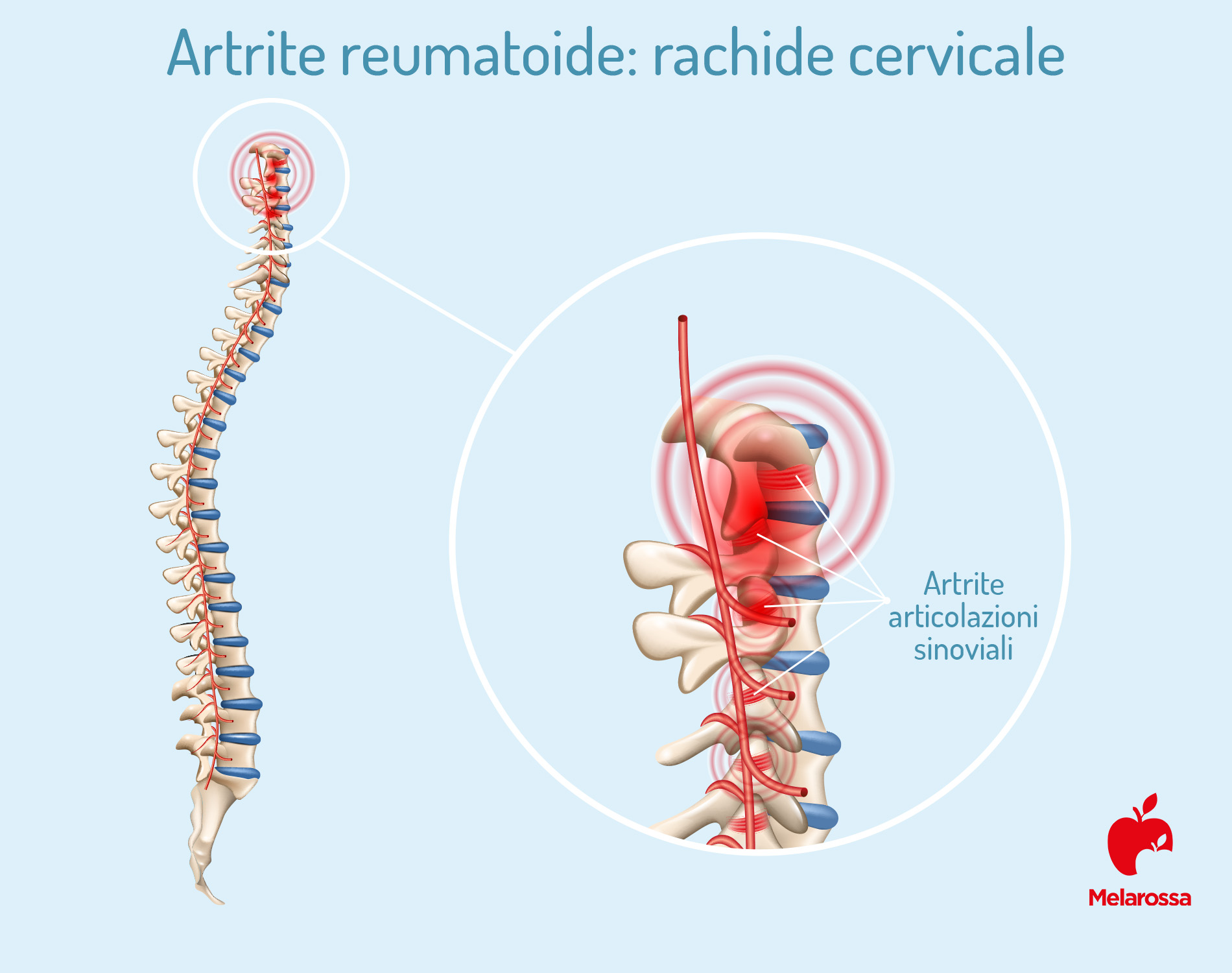 Artrite reumatoide: rachide cervicale 