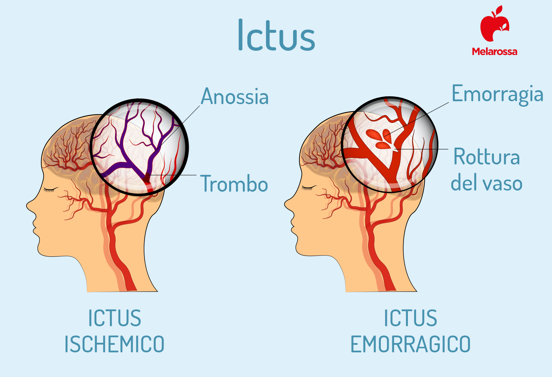 Ictus: classificazione 