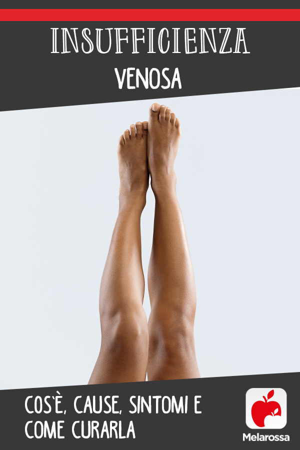 insufficienza venosa cronica: cos'è, cause, sintomi e cure