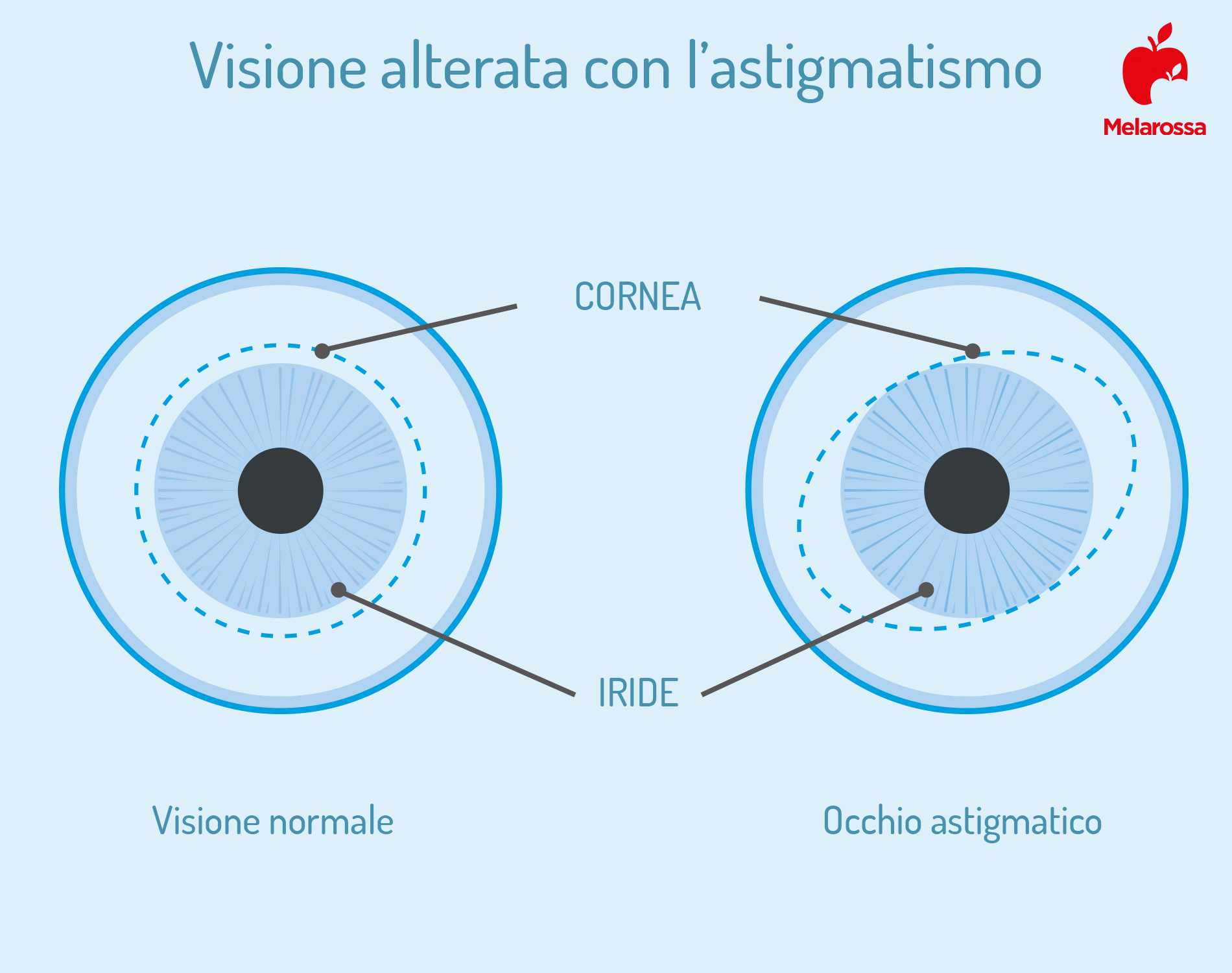 astigmatismo: visione alterata