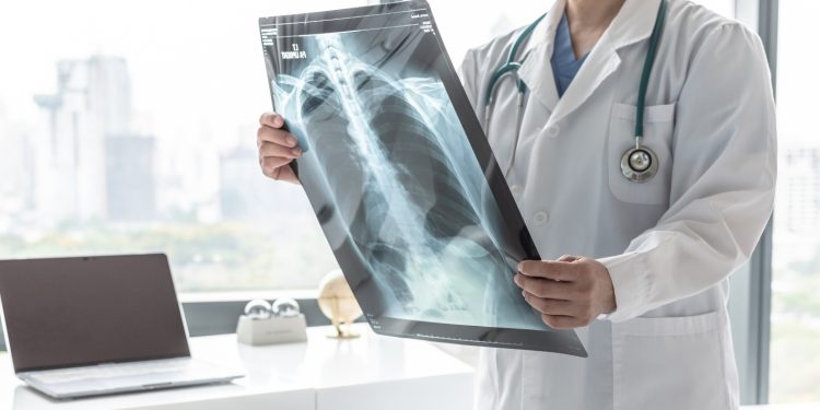 fibrosi polmonare: cos'è, cause, sintomi e cure