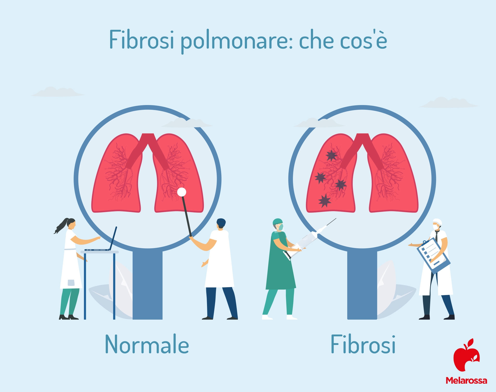 fibrosi polmonare: cos'è