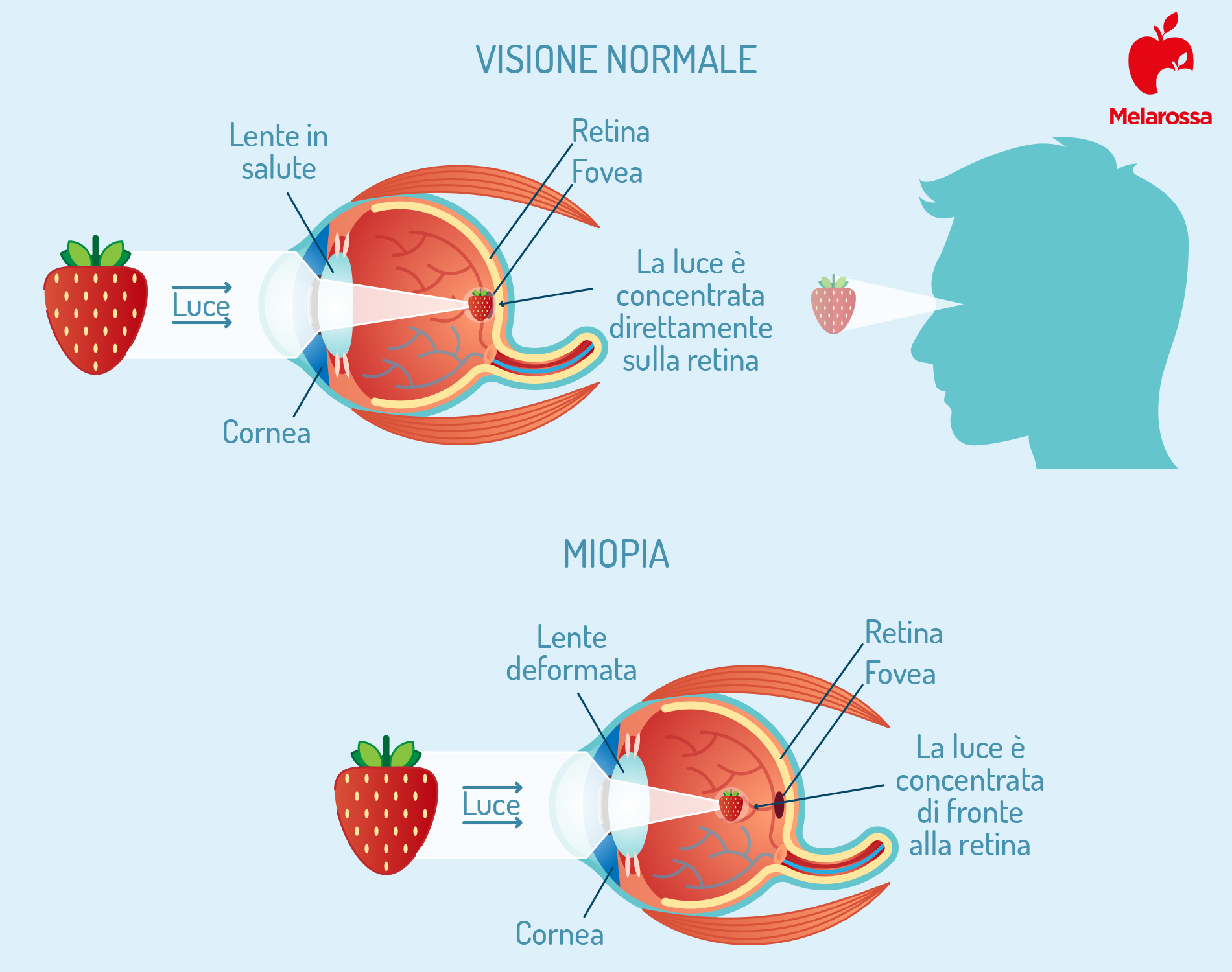 Miope non clearance vede da vicino
