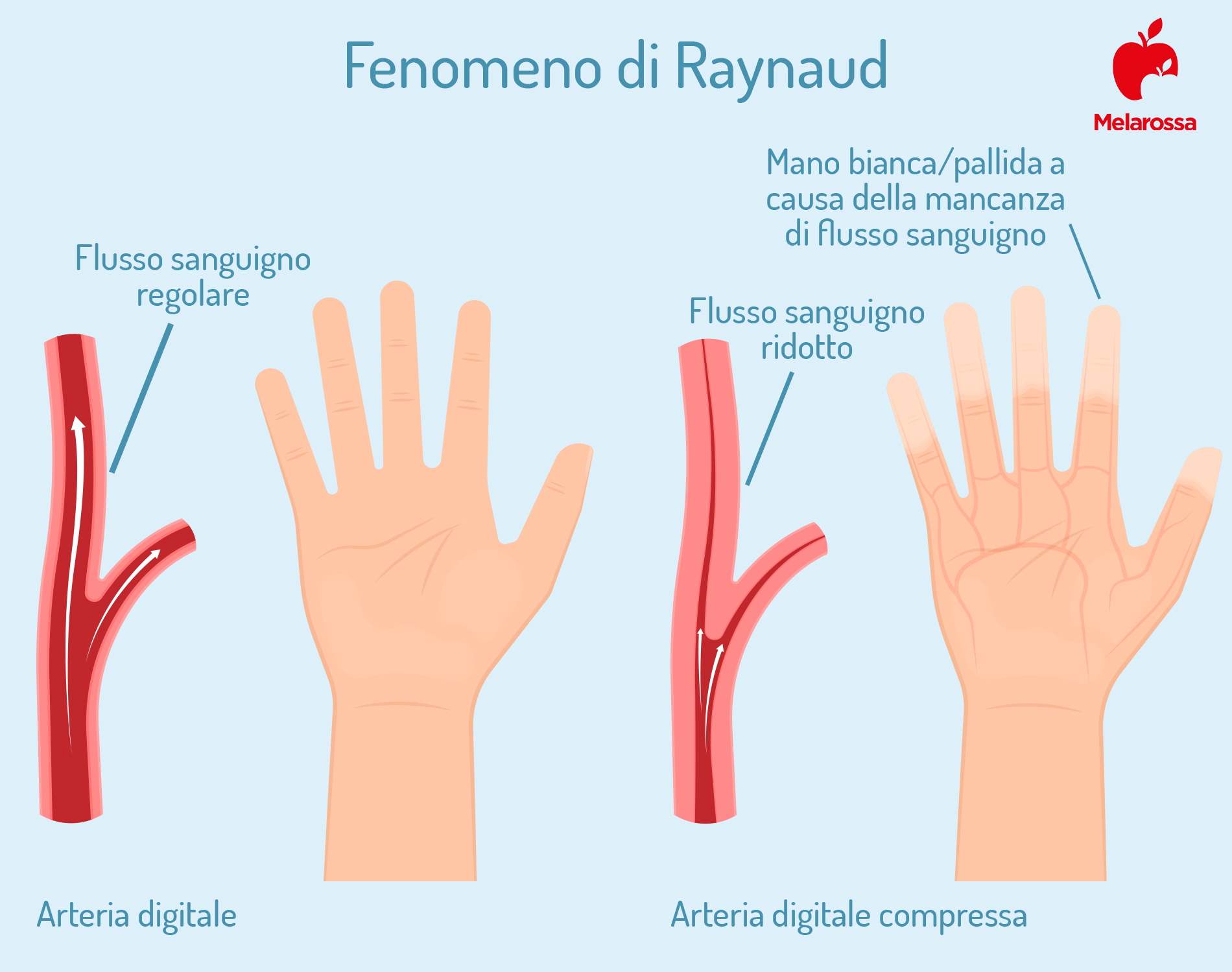 sclerodermia: che cos'è