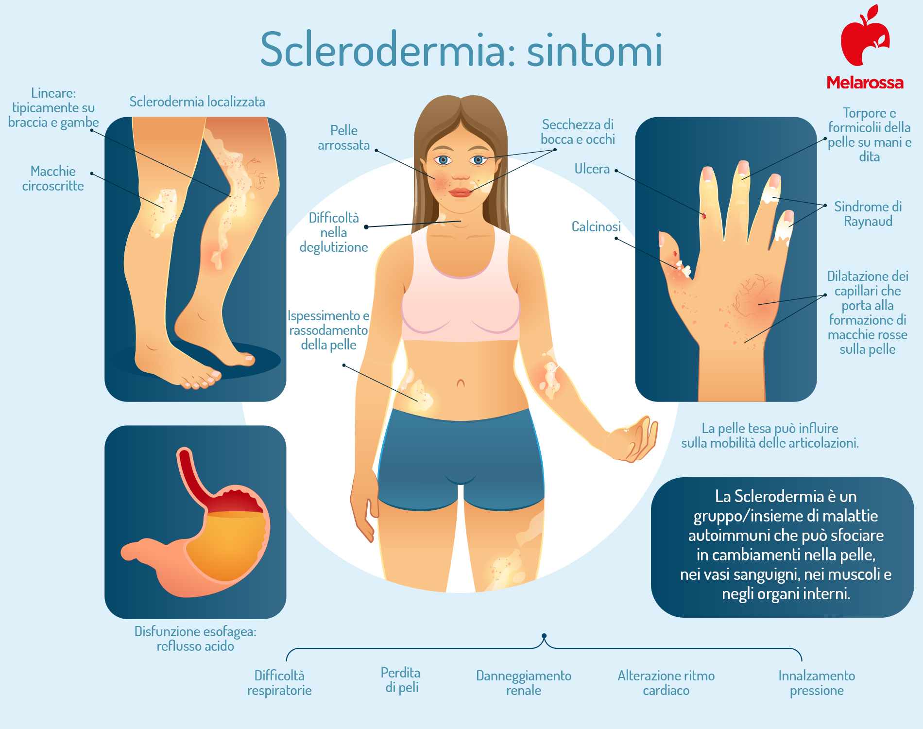 sclerodermia: sintomi