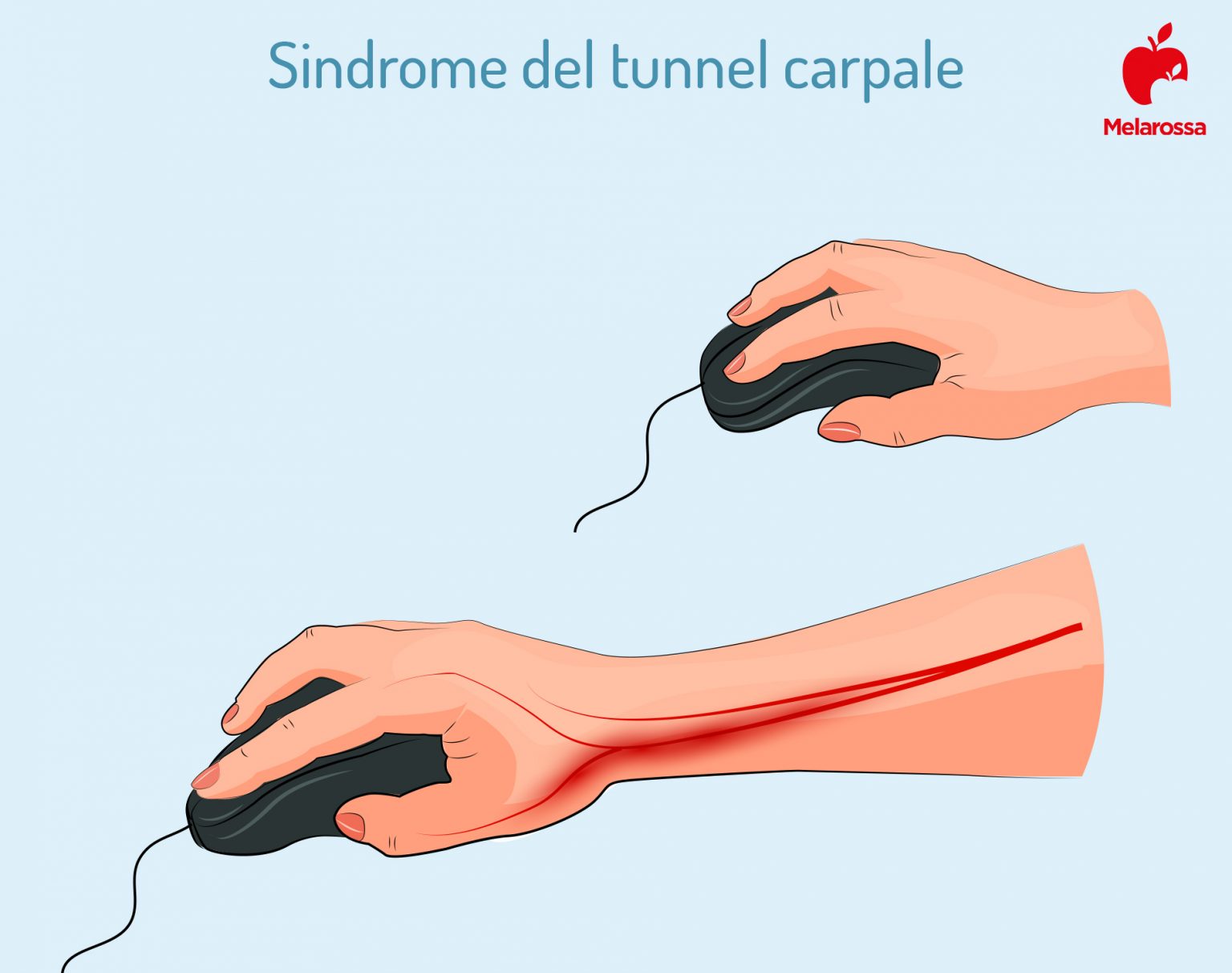 Sindrome del tunnel carpale sintomi, rimedi ed esercizi