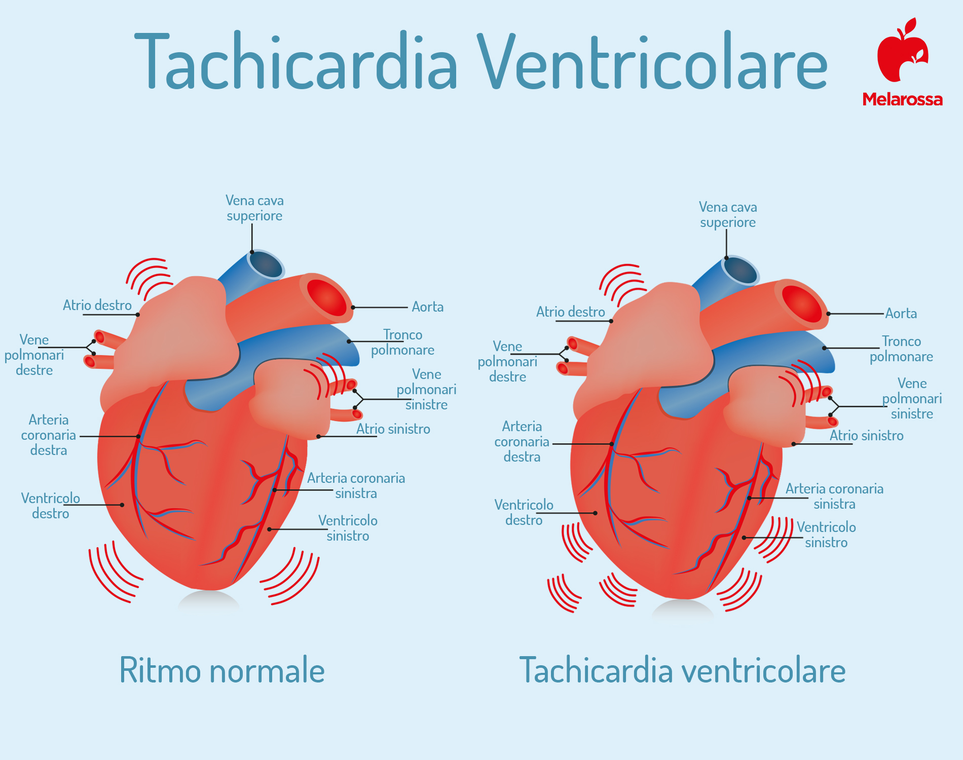 tachicardia ventricolare: che cos'è
